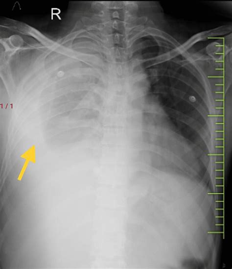 Chest X Ray Posteroanterior Pa View On Admission Showing Right Sided