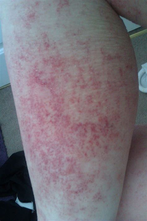 I Have Eczema