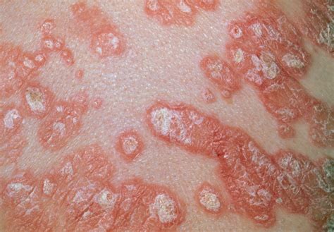 4 Common Rashes On Skin Causes Pictures Diagnosis