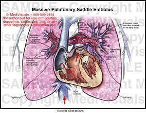 The journal of the american medical association : Massive Pulmonary Saddle Embolus Medical Illustration