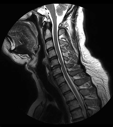 Comprehensive Cervical Spine Imaging At 30t Philips Mr Body Map