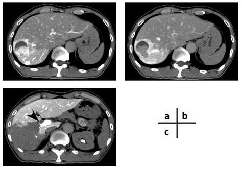 Liver Metastasis Originating From Colorectal Cancer With Macroscopic