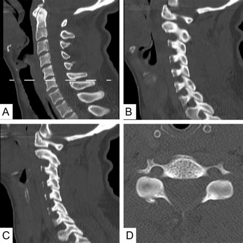 Acutely Unstable Cervical Spine Injury With Normal Ct Scan Findings