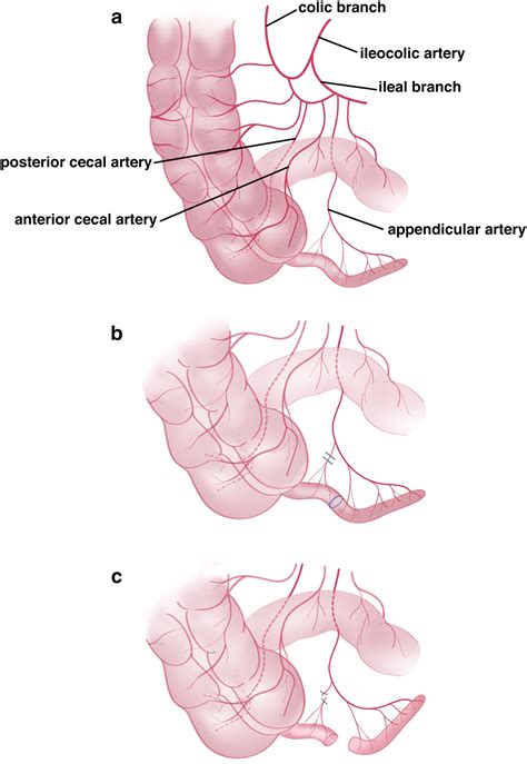 Creation Of An Appendicovesicostomy Mitrofanoff From A Preexisting