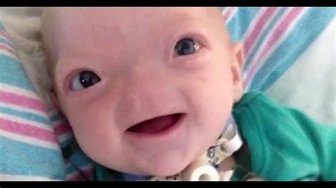 Eli The ‘miracle Baby Born Without A Nose Has Died