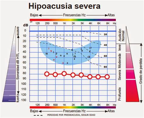 Hipoacusiaseverazoom 845×698 Speech Language Pathologists