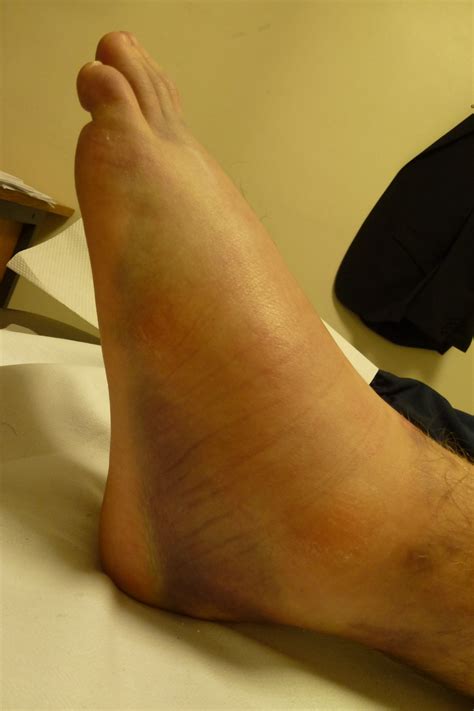 Ankle Sprain Causes Sprained Ankle Hertfordshire Uk