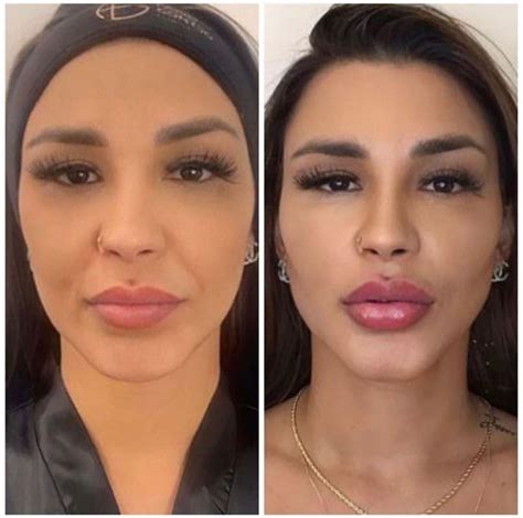 My Sex Life Sizzles After 8 Plastic Surgeries In One Day