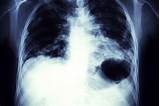 Side Effects To Lung Cancer