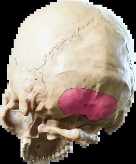 Suboccipital Craniotomy For Posterior Fossa Brain Metastasis Via