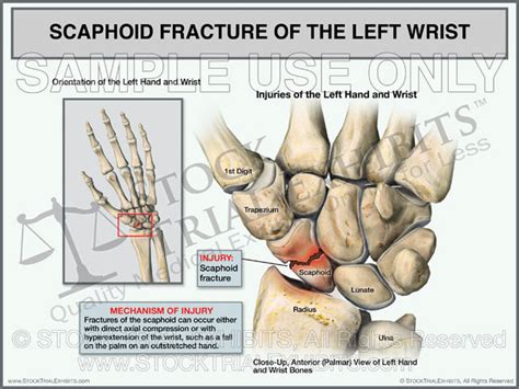 Scaphoid Fracture Of The Left Wrist Cost Effective Medical Exhibit