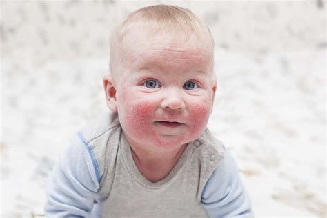 Dermatite Nei Bambini Le Foto Per Riconoscerla