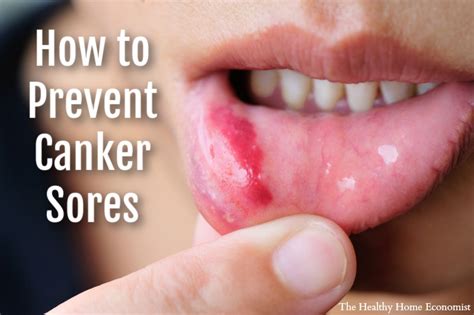 How To Stop Canker Sores Forever Healthy Home Economist