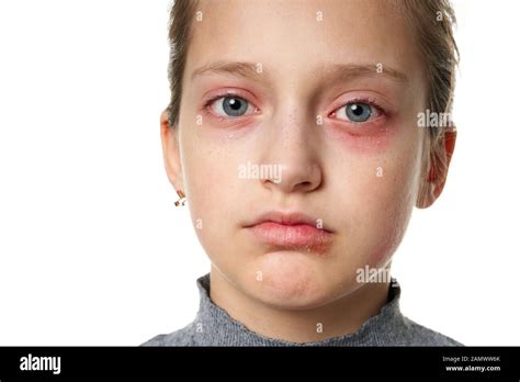 Réaction Allergique éruption De Peau Fermer La Vue Portrait Dun