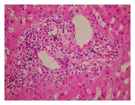 Figure 1 A Case Of Montelukast Induced Churg Strauss Syndrome