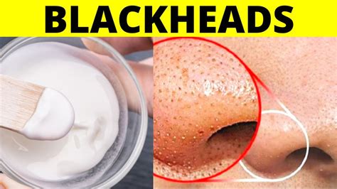 Get Rid Of Whiteheads On Nose Chin And Face Naturally Permanently