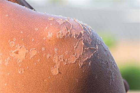 Sunburn adalah reaksi yang terlihat dari paparan kulit terhadap radiasi ultraviolet (uv) (sinar tak terlihat yang merupakan bagian dari sinar matahari), atau sumber cahaya uv, seperti tanning salon. Mengatasi Kulit Terbakar Sinar Matahari - Klinik Pulowatu