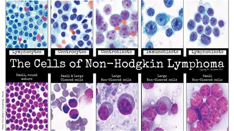 CytoThe ABCs Approach to Cytology Cases  iheartpathology