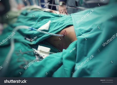 Chest Tube Insertion Procedure Under Sterile Stock Photo