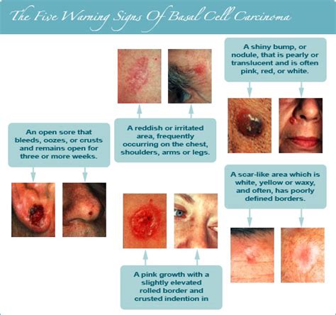 Basal Cell Cancer In Mill Valley Ca ﻿aesthetic Dermatology And Skin