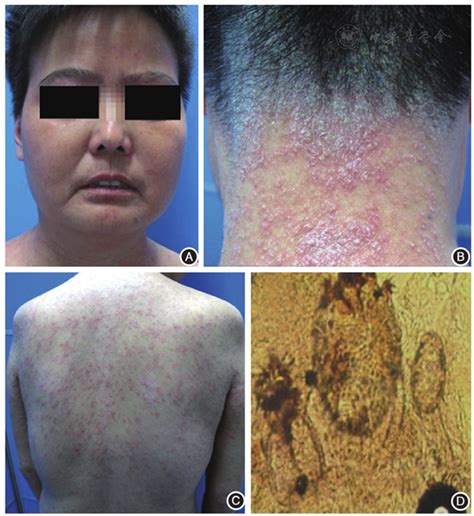 Misdiagnosed Norwegian Scabies In A Patient With Systemic Sclerosis A
