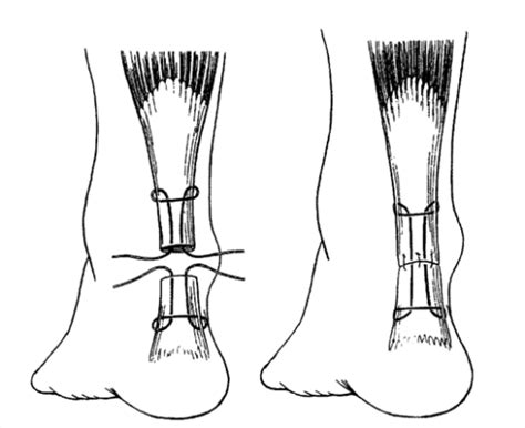 If it is small tear it might heal by itself and not require surgery; Effect and Risks of Achilles Tendon Surgery | New Health ...