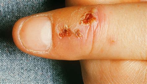 Herpes Rash Hand
