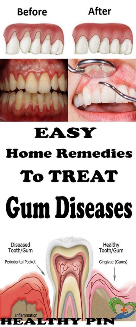 Gingivitis Usually Known As Gum Disease Is A Dental Issue Characterized