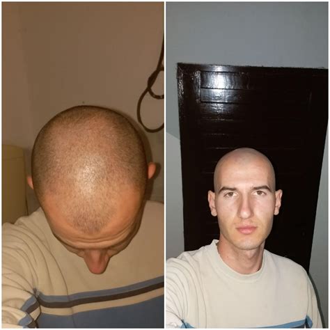20y i am forced to shave head every 2 or 3 days my baldness is