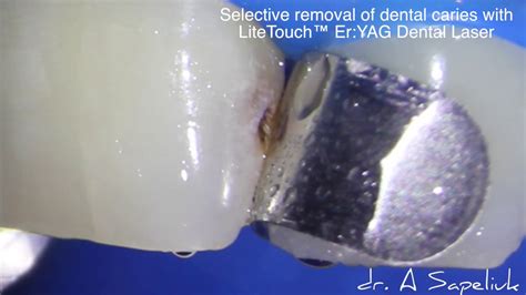 Cavity Preparation With Litetouch™ Eryag Dental Laser Youtube