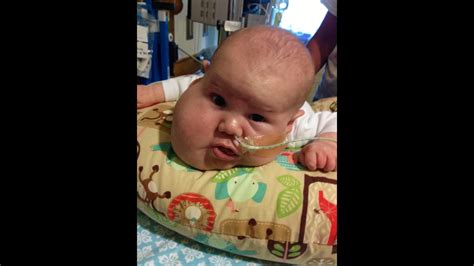 Pictures Baby Wyatt 2 Month Old With Lymphatic Malformation Wpxi