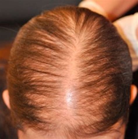 Alopecias In Lupus Erythematosus Lupus Science And Medicine
