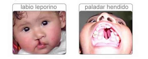 Introducción/ cleft palate speech therapy: LABIO Y PALADAR HENDIDO MALFORMACIÓN COMÚN