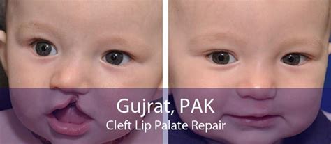 Cleft Palate Treatment Gujrat Cleft Lip And Palate Surgery Gujrat