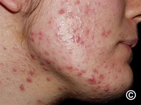 Acne Vulgaris Symptoms Pictures Treatments And More 45 Off