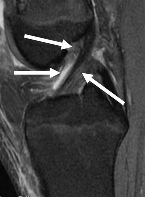 With standard acl, we can define certain conditions for the network traffic passing through the router. ACL Tear | Anterior Cruciate Ligament Injury | Knee ...