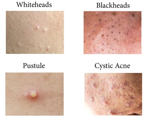 Acne Symptoms Causes And Treatments