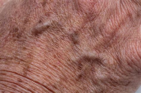 Age Spots On Elderly Skin Stock Image F0302388 Science Photo Library