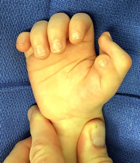Congenital Hand And Arm Differences