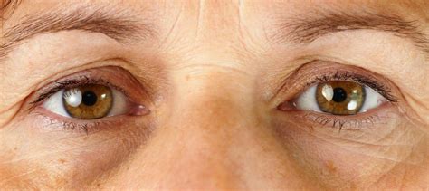 Harapan yang pernah terkulai layu. Do You Have Raccoon Eyes? What Causes Them and How to Fix ...