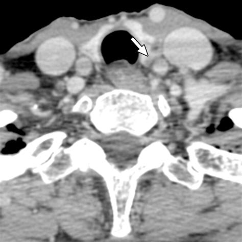 How To Perform Parathyroid 4d Ct Tips And Traps For Technique And