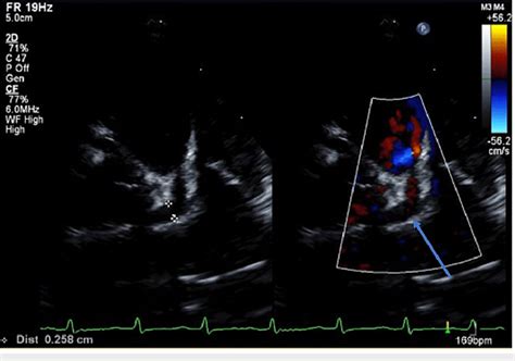 Transthoracic Echocardiogram Obtained On Day 10 Of Illness Showing A