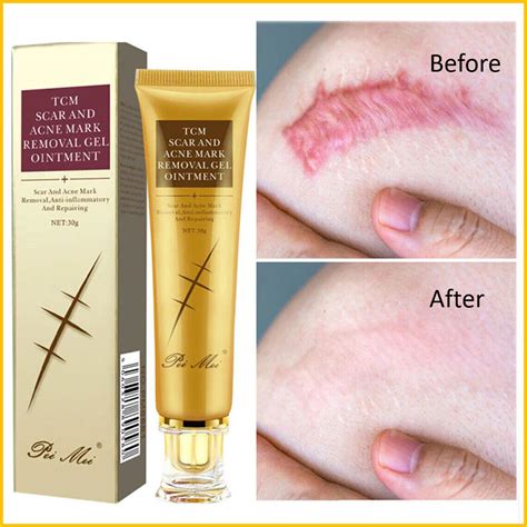 scar removal cream homecare24