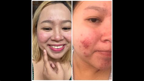 How My Pimple Huge Acne Became A Dimple Youtube