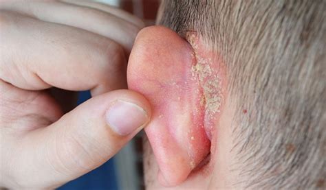 The Best 17 Sebaceous Cyst Behind Ear Treatment Artbeamall