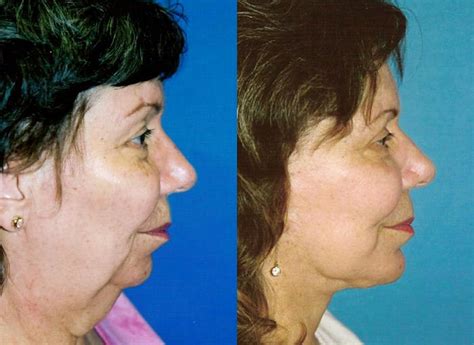 Patient 122406491 Laser Assisted Weekend Neck Lift Before And After