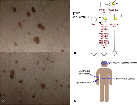Hereditary Melanoma Update On Syndromes And Management Journal Of