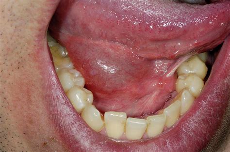 Swollen Sublingual Salivary Gland Photograph By Dr P Marazzi Science The Best Porn Website