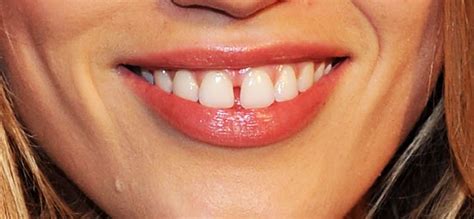 Tooth Gap Its Causes And Treatment Options
