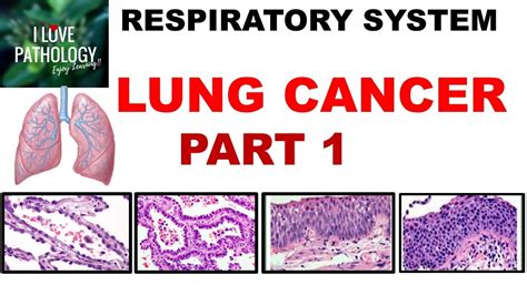 Lung Cancer Part 1 Epidemiology Etiopathogenesis Precursor Lesions